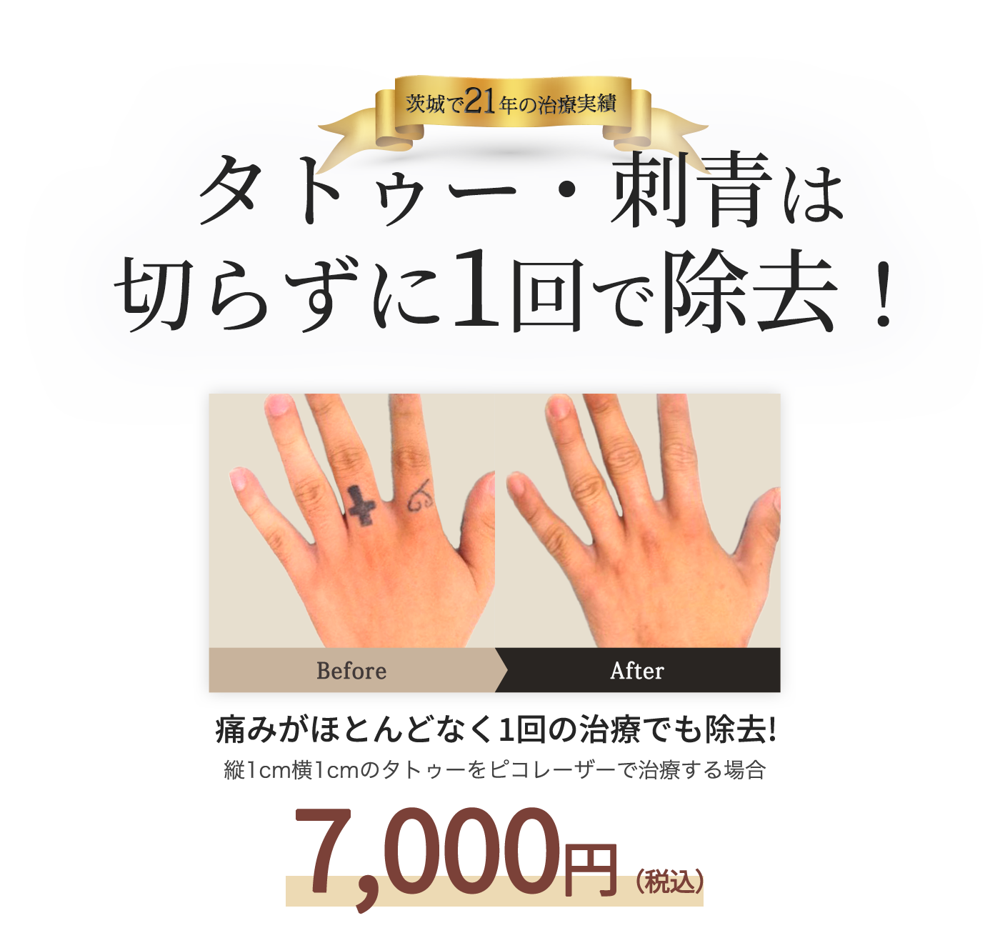 茨城で18年の治療実績 タトゥー・刺青は切らずに1回で除去!